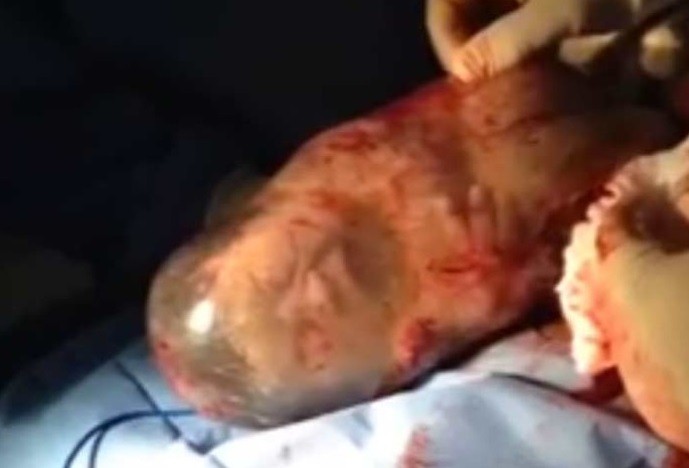 Bebê nasce dentro da bolsa amniótica, e vídeo bomba na web (Crédito: Reprodução)