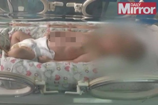 Bebê é filmado com coração batendo fora de seu corpo (Crédito: Reprodução)