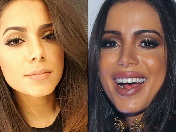 Anitta fez preenchimento labial (Crédito: Reprodução/ Instagram )