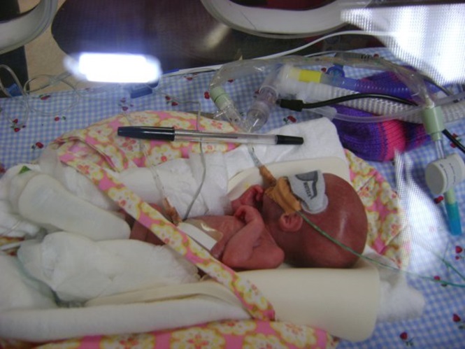 Bebê prematuro sobrevive após ficar ao lado de sua irmã gêmea (Crédito: Reprodução)