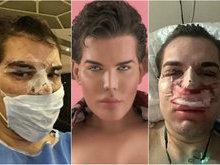 'Ken humano' brasileiro contrai bactéria comedora de carne