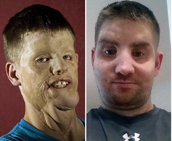 Mitch Hunter antes e depois da cirurgia (Crédito: Reprodução)