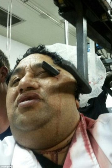 Homem ficou com gancho preso no rosto (Crédito: Reprodução)