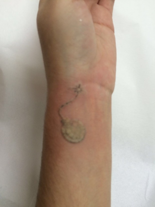 Andressa Urach remove tatuagens (Crédito: Divulgação)