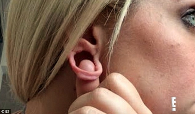 Mulher teve parte do lóbulo removido para colocar piercings