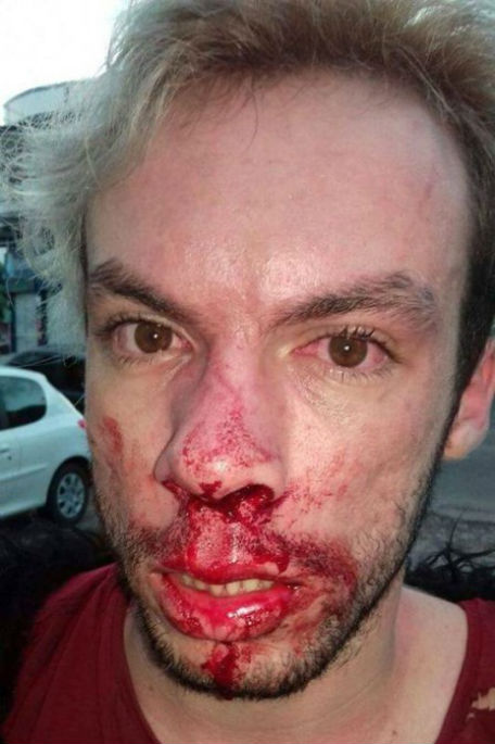 Jovem tem nariz quebrado após agressão