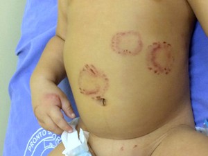 Bebê ficou com hematomas pelo corpo (Crédito: Divulgação)