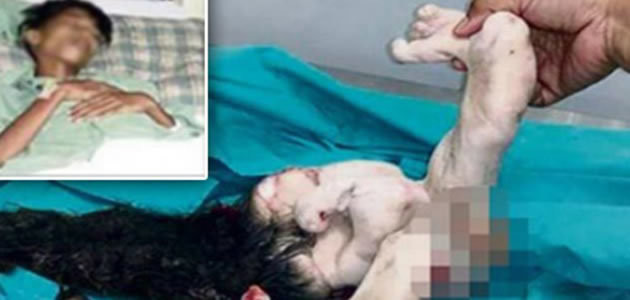 Gêmeo é retirado da barriga do irmão após cirurgia