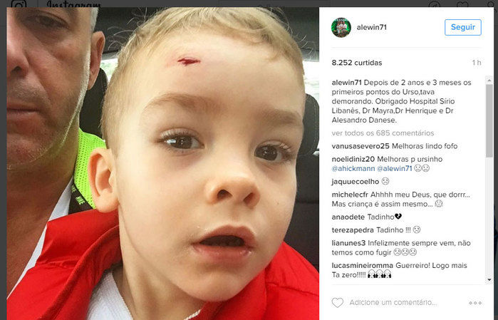 Filho de Ana Hickmann levou pontos na testa (Crédito: Reprodução/ Instagram)