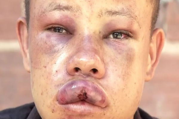 Adolescente foi agredido após surto psicótico