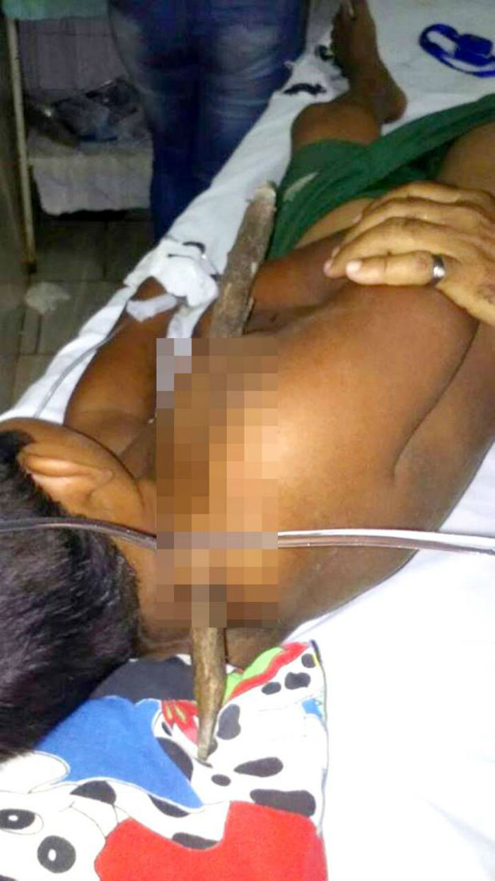 Garoto ficou com estaca atravessada no peito (Crédito: Reprodução)