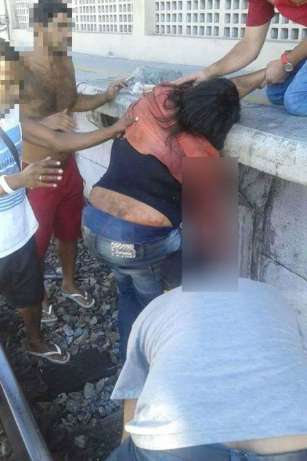 Em acidente, mulher teve parte do braço amputado