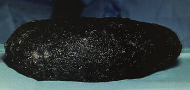 Médicos tiram bola de cabelo de 6kg de estômago de jovem