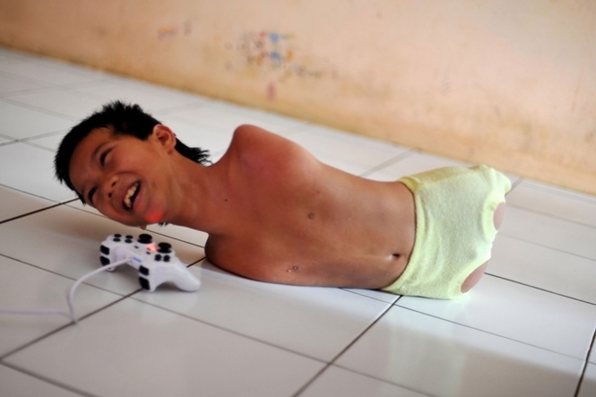 Garoto sem braços e pernas (Crédito: Divulgação)