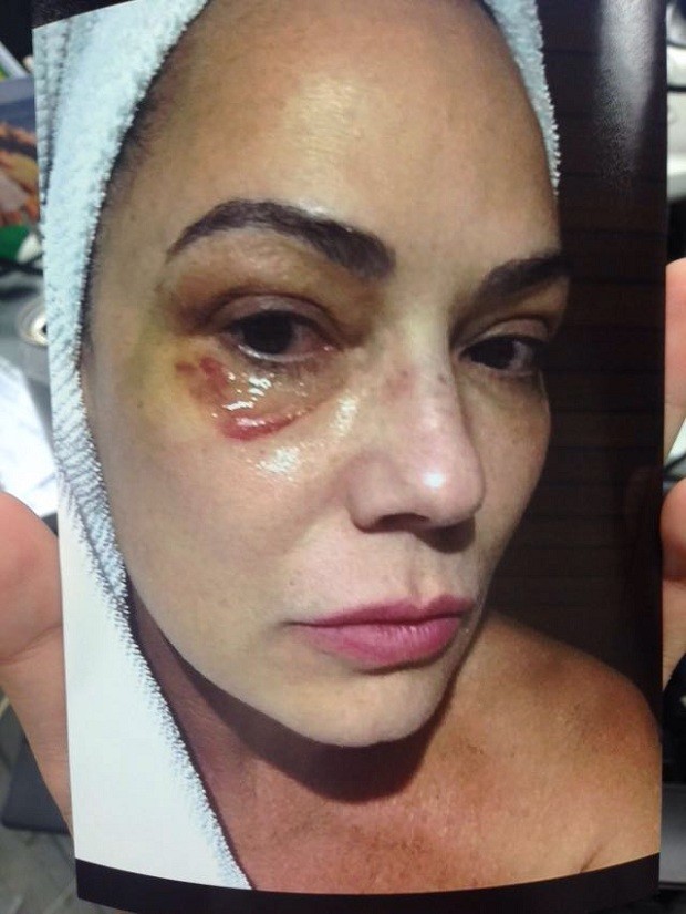 Luiza Brunet após a agressão (Crédito: Reprodução)