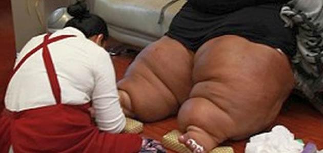 Mulher sofre com inchaço nas pernas que pode causar morte