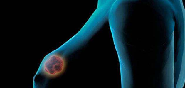 Confira 8 coisas que você precisa saber sobre o câncer