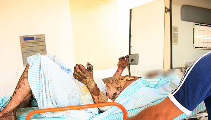 Jovem teve o corpo totalmente queimado (Crédito: Piracurucaaovivo)