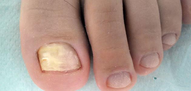 Saiba como se prevenir das micoses das unhas