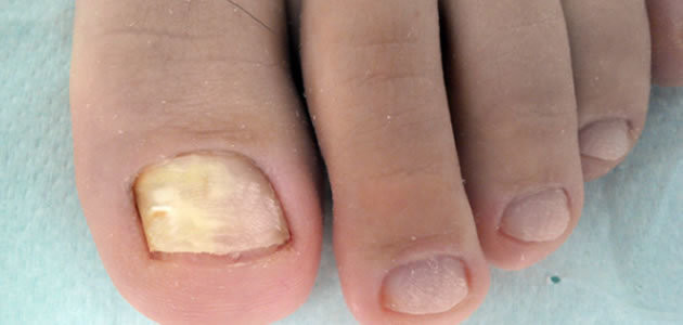 Saiba como se prevenir das micoses das unhas