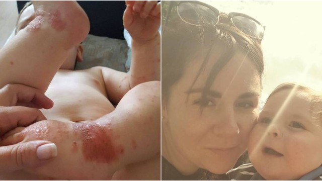Bebê contraiu herpes (Crédito: Reprodução)