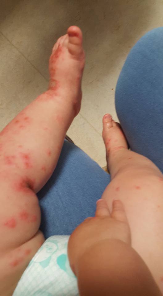 Bebê contraiu herpes (Crédito: Reprodução)