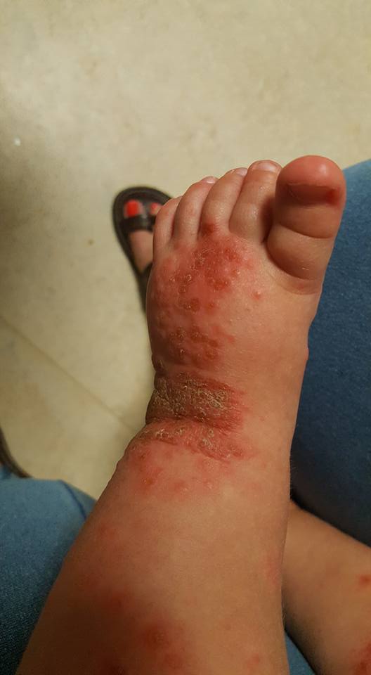 Bebê contraiu herpes (Crédito: Reprodução)