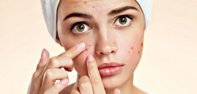 5 coisas que não se deve fazer com acne