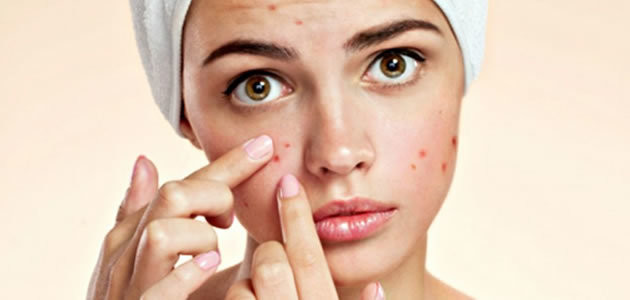 5 coisas que não se deve fazer com acne