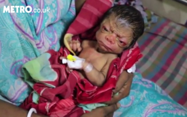 Bebê nascido na Índia foi diagnosticado com progéria