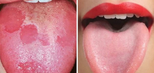 8 sinais que a língua pode dizer sobre a sua saúde