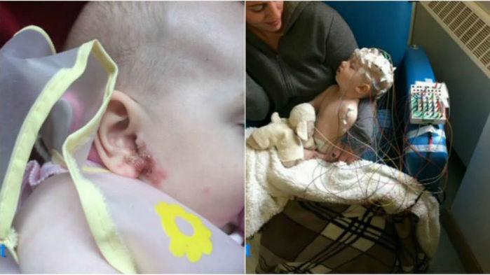 Bebê contraiu herpes através de beijo da mãe