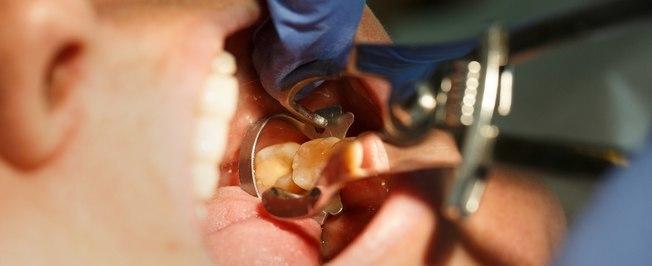 Droga pode regenerar dentes e aposentar as obturações