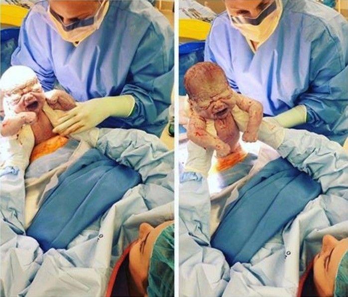 Mulher puxa o próprio bebê do útero durante parto cesariana (Crédito: Reprodução)