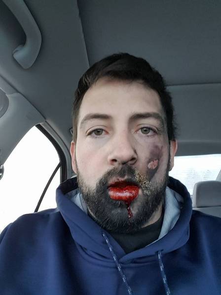 Homem perde dentes em explosão de cigarro eletrônico