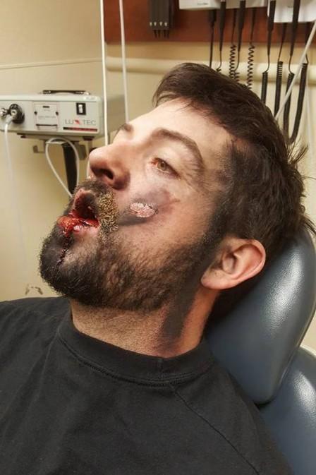 Homem perde dentes em explosão de cigarro eletrônico