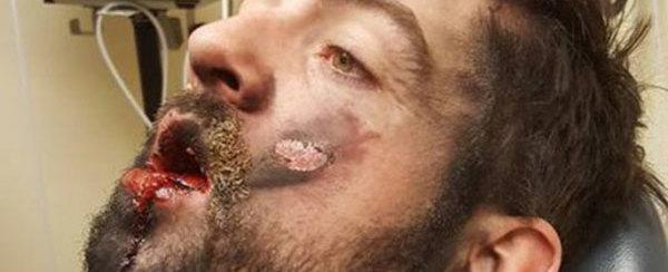 Psicólogo perde sete dentes em explosão de cigarro eletrônico