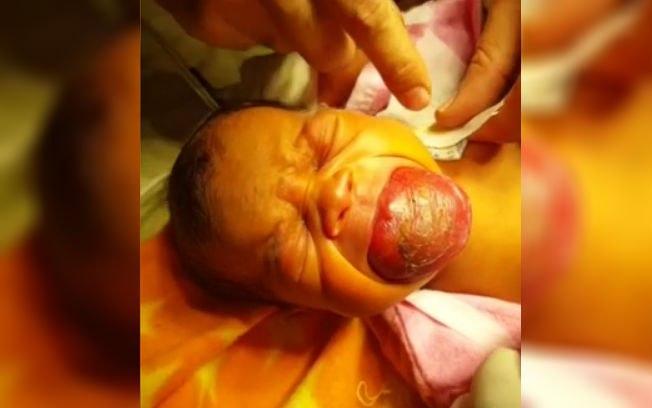 Bebê quase morre sufocado por nascer com anomalia rara