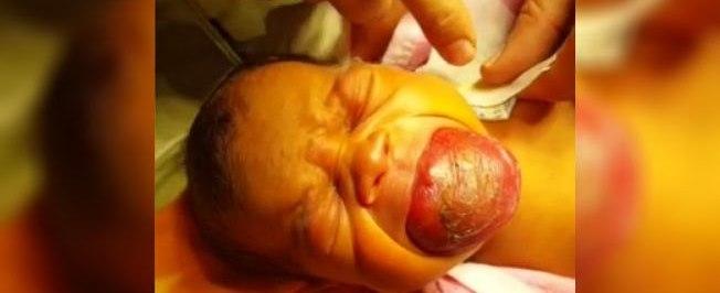 Bebê quase morre sufocado por nascer com uma língua gigante