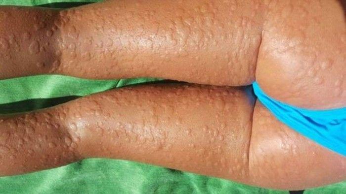 Para evitar os sintomas, Beatriz Sánchez toma quatro comprimidos de anti-histamínicos diariamente (Crédito: Reprodução)