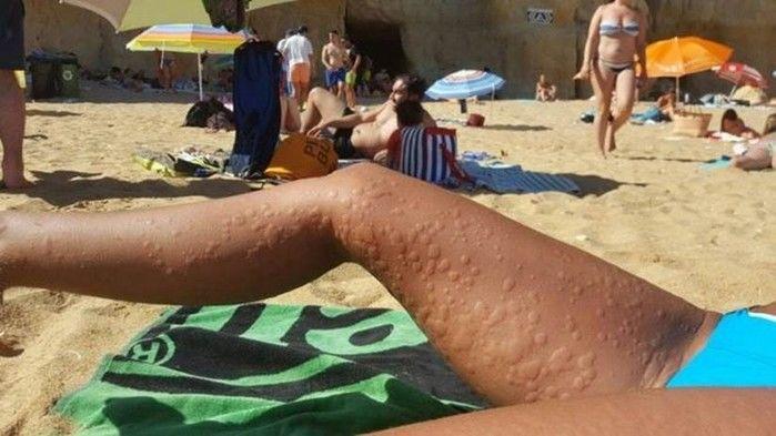 No verão, a brisa fresca da praia foi suficiente para encher de urticária o corpo de Beatriz Sánchez (Crédito: Reprodução)