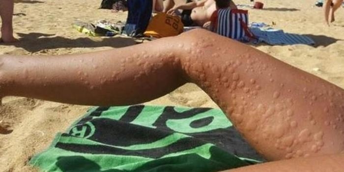 Mulher espanhola fala sobre o drama de ter alergia ao frio