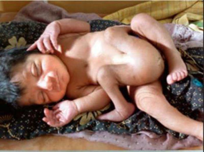 Bebê nasce com quatro pernas e dois pênis