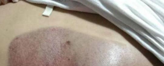 Mulher tem costas sugadas em piscina, e faz relato em rede social