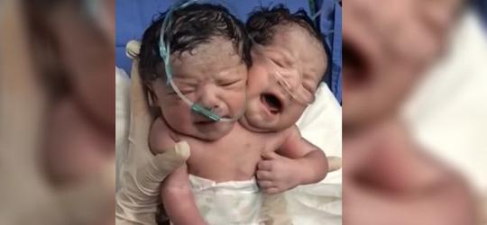 ‘Bebê com duas cabeças’ nasce no México