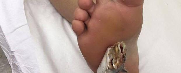 Jovem com alergia a peixes fica com bagre preso no pé: "Susto"