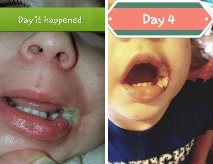 Bebê ficou com queimaduras na boca por causa de carregador (Crédito: Reprodução/Facebook)