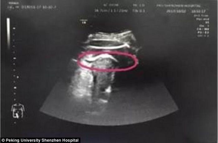 A área destacada mostra o pé da criança para fora do útero