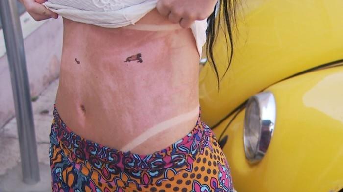 A mulher sofreu queimaduras de segundo grau após bronzeamento (Crédito: Alexandre Sá/EPTV)