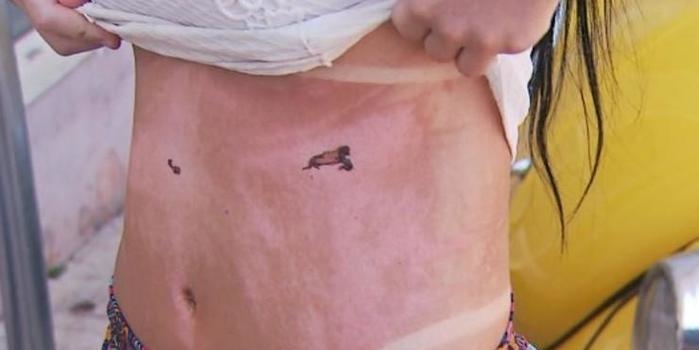 Mulher faz sessão de bronzeamento e fica com queimaduras no corpo